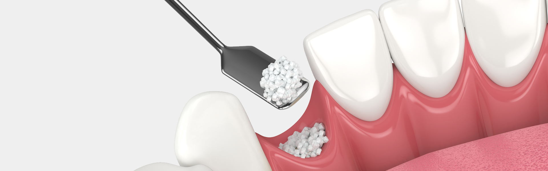 Introduction to Dental Bone Grafts