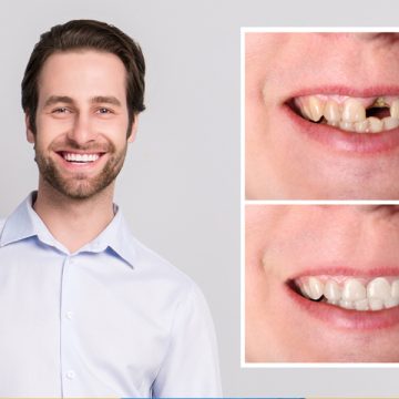 Dental Crown Maintenance Tips from a Salem Dentist