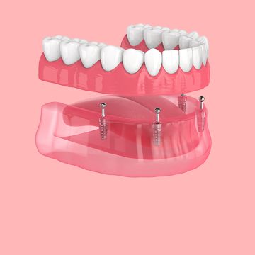 All-On-4® Dental Implants in Salem: Are They the Right Option for You?