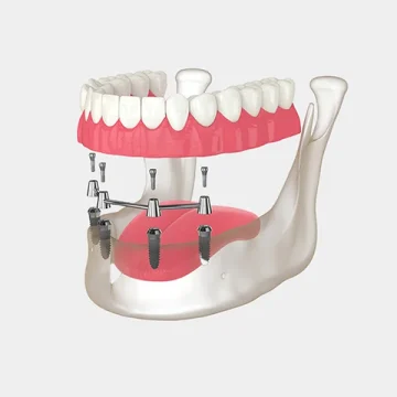 All-on-4 Dental Implants in Salem, MA: Restore Your Smile in Just One Day