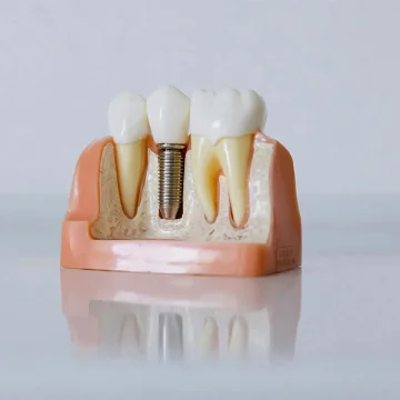 Common Problems with Dental Implants and How to Avoid Them