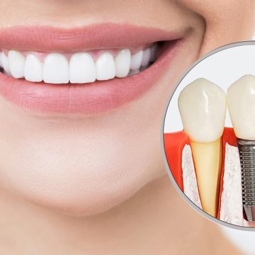 What to Eat After Dental Implant Surgery: Recovery Tips for Salem, MA Patients